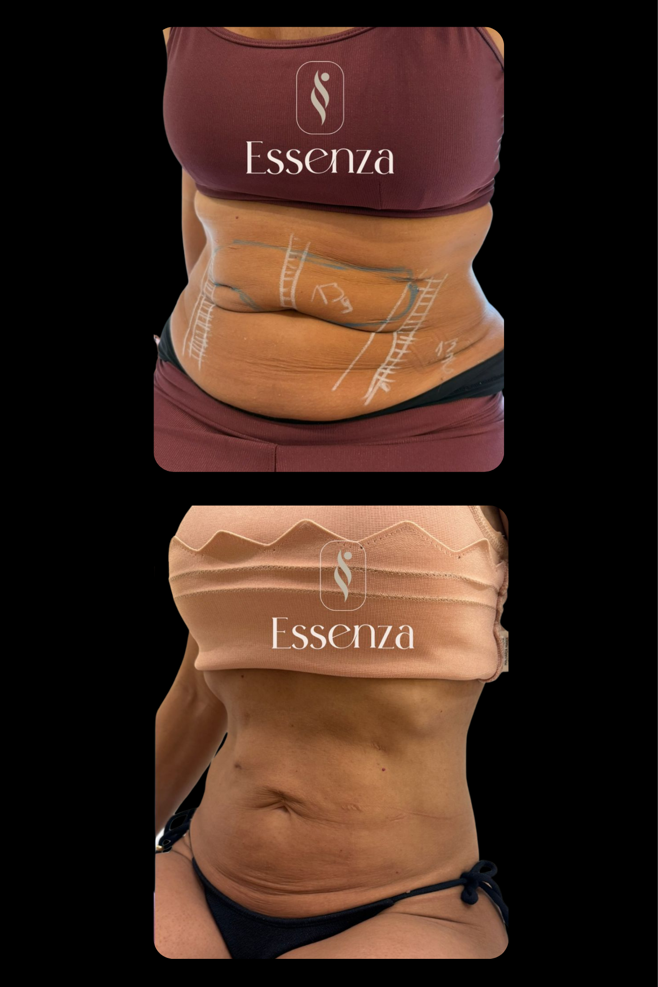 Antes e depois resultado HIPRO